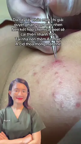 Trị mụn kết hợp đa phương thức sẽ nhanh cải thiện hơn #bsthuphong #LearnOnTikTok #chamdakhoahoc #trimun 