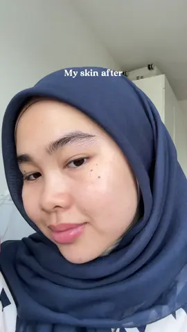 If u tengah naik jerawat try this acne cleanser from g2g  #acnecleanser #glad2glow #g2g #fyp #skincare 