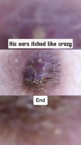 His Ears Itched Like Crazy End #earwax #ear #earwaxing #fyp #foryou #asmr #earwash #earcleaning #earwaxcleaner #foreignbodyremoval #doctors #earwaxremoval #removing #earcleaningasmr #washing #relaxingvideos #dry 