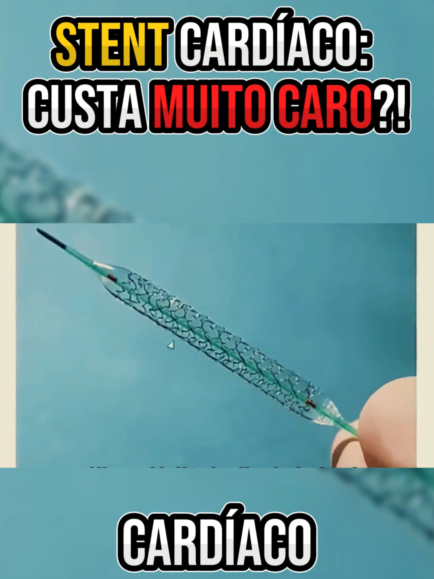 Quanto custa um stent cardíaco? #curioso #curiosidades #fatoscuriosos #stent #cateterismo