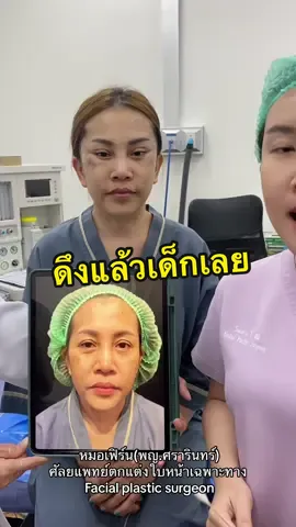 ดึงแล้วเด็กเลย #หมอเฟิร์นดึงหน้า #หมอเฟิร์นnsc #nscclinic #ทีมแพทย์nsc #facelift #ดึงหน้าแผลสวย #ดึงหน้า #ดึงหน้าถาวร #ศัลยกรรมดึงหน้า #ศัลยแพทย์ตกแต่งเฉพาะทาง #ดึงหน้าเด็ก #ดึงหน้าซ่อนแผล 