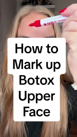 How to mark up the upper face for Botox. Where should you inject and where not too inject.  #botoxqueen #botox #upperfacebotox #fyp #aesthetics #hollylouiseaesthetics #smoothskin #antiaging #skincaretips #injections 