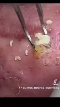 #puntosnegros #espinillas #barro #sacandoespinillas #asmr #fy #fyp #skincare 