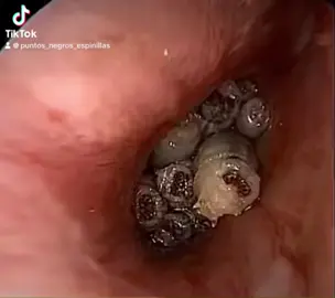Otro nivel #puntosnegros #puntosnegros #espinillas #barro #sacandoespinillas #asmr #fy #skincare #fyp #barros #gusano #xtreme 