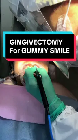 Super worth it!!! #gingivectomy #gingivec #gumsurgery #gummysmile #gingivectomysurgery #smile 