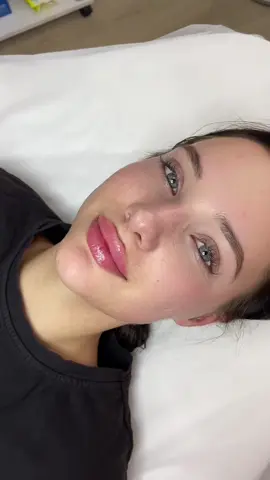 Первинні губки💋 1 мл #збільшеннягуб #контурнаяпластикагуб #аугментациягуб #lips #плоскийбант #губи 