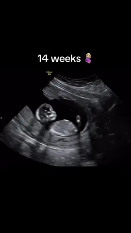 Life at 14 weeks #ultrasound #3dultrasound #4dultrasound #hdliveultrasound #baby #3d4dultrasound #babygirl #babyboy #fyp ##pregnancy #10k #trendingsound #14weeks #14weekspregnant #2ndtrimester