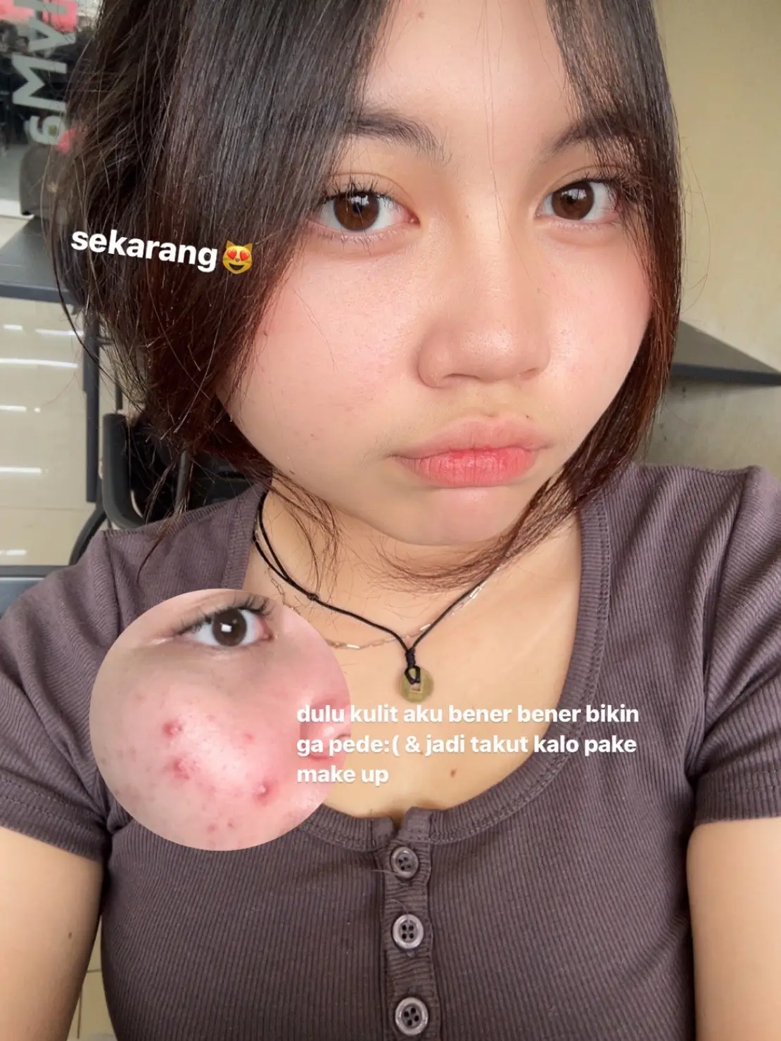 mantul banget ni peeling serum😻🫶🏻 #skincare #acneskin 