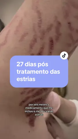 27 dias pós tratamento das estrias 🥹 #corticoide #estrias #tratamento #engordar #emagrecimento 