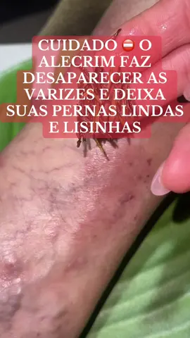 #receitacaseira #varizessemcirurgia #alecrimnasvarizes #tiktokviral 