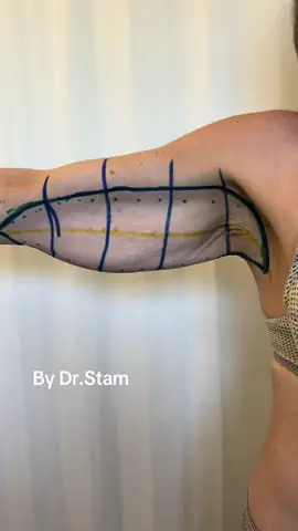#arm #armlift #tiktok #fyp #fypage #fypシ゚ #fypageeee 