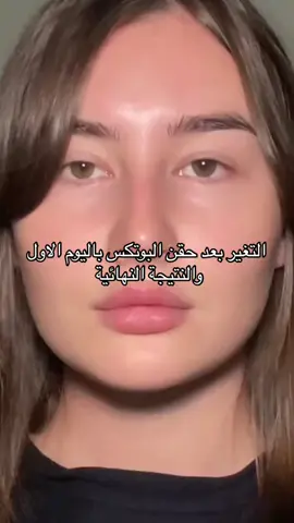 كم تتوقعوا جلسة عملت ؟ #قبل_بعد #حقن #بوتكس #فك 