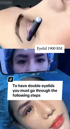 To have double eyelids you must go through the following steps #eyelid #comesticsurgery #kualalumpurmalaysia #malaysia #indonesia #tiktokmalaysia #dryangnam #fybシ 