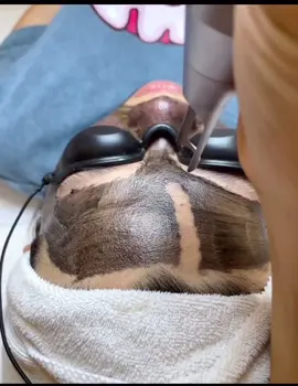 LẦN BẮN LASER CACBON THAN HOẠT TÍNH TRẺ HOÁ = 🔟 LẦN ĐI CHĂM SÓC DA SIÊU HIỆU QUẢ 😉 #camau #f#k #lamdep