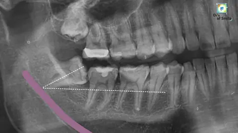 𝙎𝙪𝙧𝙜𝙞𝙘𝙖𝙡 𝙚𝙭𝙩𝙧𝙖𝙘𝙩𝙞𝙤𝙣 𝙤𝙛 𝙈𝙚𝙨𝙞𝙤𝙖𝙣𝙜𝙪𝙡𝙖𝙧 𝙞𝙢𝙥𝙖𝙘𝙩𝙚𝙙 𝙒𝙞𝙨𝙙𝙤𝙢 𝙩𝙤𝙤𝙩𝙝 𝘿𝙚𝙢𝙤𝙣𝙨𝙩𝙧𝙖𝙩𝙞𝙤𝙣 𝙨𝙩𝙚𝙥 𝙗𝙮 𝙨𝙩𝙚𝙥 𝙥𝙧𝙤𝙘𝙚𝙙𝙪𝙧𝙚🦷🧑‍⚕️ #dr_of_smile #i_love_dentistry❤ #foryou #foryoupage #video #viral #trending #viralvideo #viraltiktok #grow #account #dentist #tiktok #tiktokpakistan #unfrezzmyaccount 