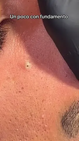 #extraction #puntosnegros #poros#granos#acne#espinillas#