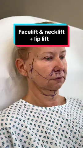 2 days after a deep plane facelift, deep necklift and lip lift👌 How do you like the transformation just 2 days after?😊 All done under local anesthesia💪 📲 If you want to make an appointment, contact us at contact@v-clinic.cz #facelift #necklift #liplift #plasticsurgery #plasticsurgeon #plastickachirurgie #ventruba #vclinic #transformation #beforeandafter