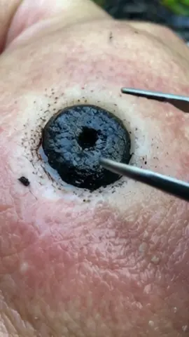 #satisfying #pilimultigemini #blackhead #squeeze #pimple #dermatology #neverfear