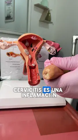 La mayoría de las veces, la cervicitis no provoca signos ni síntomas, por lo que solo te enterarás de que tienes la enfermedad después de que el médico realice un examen pélvico por otro motivo. Si tienes signos y síntomas, pueden ser los siguientes: -Grandes cantidades de un flujo vaginal inusual -Micciones frecuentes y dolorosas -Dolor durante las relaciones sexuales Recuerda que cuidar tu salud es tu responsabilidad. Dr Rafael Méndez  Ginecólogo & Obstetra  #drrafaelmendez #ginecologord #cervicitis #infeccion #jjrestetica #grupomedicosanmartin #ginecologo #obstetrard
