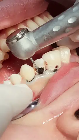 Deep tooth caries treatment with RCT , fiber post and composite restoration , ready for the zirconia crown next visit #dentist 