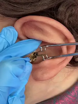 Gold chain removed from ear. A doctor removed a gold chain from a patient's ear.