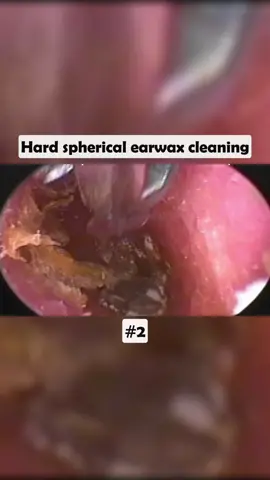 Hard spherical earwax cleaning #earwax #ear #earwaxing #fyp #foryou #asmr #earwash #earcleaning #earwaxcleaner #foreignbodyremoval #doctors #earwaxremoval #removing #earcleaningasmr #washing #relaxingvideos #dry 