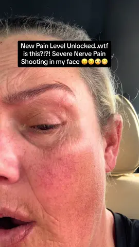 Just anotger random painful sympton on my face 🦓😣😳😬😖💪🏼❤️‍🩹🥄 #radzebra #hEDS #crps #facialpain #nervepain #chronicpain #ehlersdanlossyndrome #nerves #ehlersdanloscomorbidities #🦓 