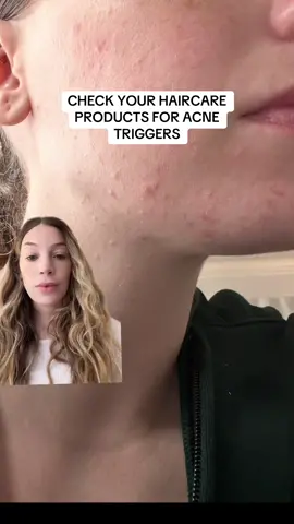 Thats about 5k in dermatologist apts and facials Ill never get back 🥲#skintok #acneskin #skincareroutine #skinsort #foryou #greenscreen 