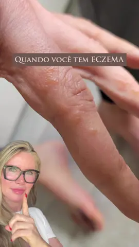 Você já ouviu falar em eczema? ⚜️Nas mãos, também conhecida como disidrose, é uma condição de pele caracterizada por pequenas bolhas (vesículas) que coçam muito. ⚜️ Embora a causa exata da disidrose seja desconhecida, observa-se que pode ter origem exógena (fatores externos ou de contato) ou endógena (fatores individuais; como o estresse, que é um fator de piora bem conhecido). Descartar alergia a determinadas substâncias pode fazer parte do processo de investigação. ⚜️ Disidrose pode ser confundida com outros problemas. Dermatite alérgica de contato, dermatite de contato irritativa (por irritante primário), micose, dermatite atópica são diagnósticos diferenciais. ⚜️ O tratamento envolve medidas para aliviar os sintomas, evitar gatilhos, usar sabonetes suaves, hidratantes reparadores e medicamentos antiinflamatórios (corticoide) em alguns casos.  ⚜️ Embora não seja uma condição grave, a disidrose pode ser desconfortável, enfatizando a importância de orientação médica adequada. Você conhece alguém que tem disidrose? #disidrose #eczemadisidrótico #eczema #saúdedapele #mãos #dermatologista #dermato #dermatologia #alergia #tratamento #brasilia #df #dracristinasalaro #dermatobsb 