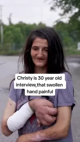 Christy is 30 year old interview,that swollen hand painful #christyhomeless #christyswollenhand #swollenhand #homelessinterview #homelesspeople #homelessness #talesfromthestreets #lostinphoenix 