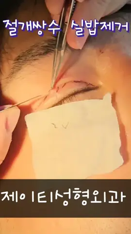🍀제이티 절개쌍꺼풀 실밥제거 중  - #7일차 #눈성형 #실밥제거  #릴스 #틱톡 #신사 #가을 #셀카 #영상 #비포애프터 #beforeafter #성형후기 #제이티 #제이티성형외과 #신사성형외과 #눈성형 #절개쌍수 #절개쌍꺼풀 
