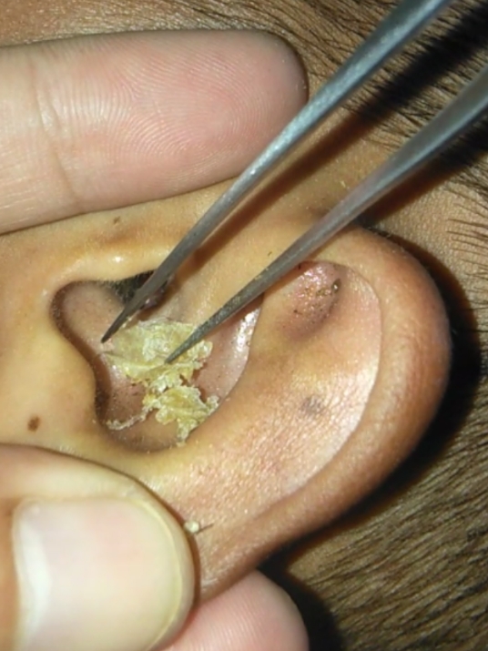 #relaxing #foryou #satisfyingvideo #earwaxremoval #ASMR #earwaxcleaning #earwax 
