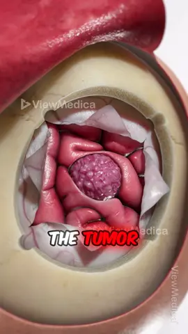 Brain Tumor Removal (3D Animation) #brain #craniotomy #meningioma #tumor #removalanimation #medicalanimation #medicaleducation #braintumor