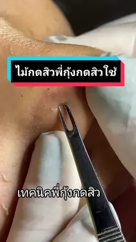 #กดสิว #ไม้กดสิว #กดสิวอุดตัน #ไม้กดสิวหมอมวลชน #นักปั้นอาชีพกดสิว #พี่กุ้งกดสิว #เทคนิคพี่กุ้งกดสิว #สอนดูผิว #สิว #ลูกศิษย์พี่กุ้ง #ceoพี่กุ้งกดสิว #tiktokuni #เมนูดังtiktok #สอนกดสิว #กดสิวมืออาชีพ  #ได้ความรู้แบบเพลินๆ 
