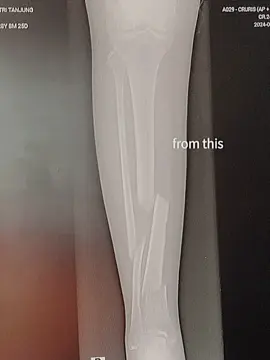 cepet nyambung yaa tulangkuuuu , cepet sembuh seperti sedia kala..aamiin #frakturtibiafibula #pejuangfraktur #fypdongggggggg #bissmillahfyp 