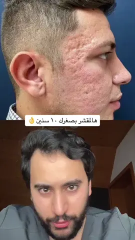 تقشير الفينول، أو كما يسمى “تقشير بيكر-غوردون”، هو من أقوى أنواع التقشير الكيميائي وبيستخدم عادةً لعلاج التجاعيد العميقة وأضرار الشمس والندبات.  … فعال جدا ومناسب لاصحاب البشرة الفاتحة I-II( للاشخاص يلي بشرتهم سمراء  غير منصوح به لانه يسبب تصبغات) .. هالتقشير بيشيل الطبقات العميقة من الجلد، وبيشيل التجاعيد العميقة والندبات العميقة. .. بس مع هيك، العملية هاي مو سهلة وفيعا مخاطر كبيرة. من اكتر الأعراض الجانبية إنه لون الجلد اللي تقشّر ممكن يفتح، وكمان بيفقد الجلد قدرته إنه يتسمّر بهي المناطق.  .. كمان في خطر على القلب لأنه الفينول ممكن يكون سام، وبيحتاج المريض أحيانًا لمراقبة طبية أثناء العملية..(احيانا نحتاج لطبيب تخدير حسب المركز) .. فترة الشفاء طويلة وبتحتاج أسابيع أو شهور، وفيها تورم واحمرار وألم. .. بس النتائج بالاخير فعلا خارقة اذا انعمل صح