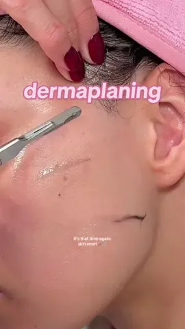 Its that time again to reset my skin🪒🩷 dermaplaning  Oil i use - @e.l.f. Cosmetics blue-ty sleep night oil  #dermaplaning #skincare #shavingmyface #dermaplanefacial #facial #skintips (not an ad, products were gifted, no obligation to post) disclaimer: please seek professional advice before you proceed with this❤️