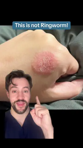 This is not ringworm! This skin condition causes itchy round and ring-shaped spots on the skin that don’t get better with ringworm treatment! #dermarkologist #eczema #greenscreen 