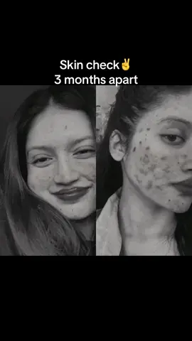 #duet with @Mamata #acne  Here is Skin check✌️ 3 months ago vs now🙂  #acneskin #acneproneskin #acneskincheck #acnepositive #darkspots 