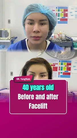 40 years old before and after facelift #facelift #comesticsurgery #indonesia #tiktokindonesia #dryangnam #fybシ 