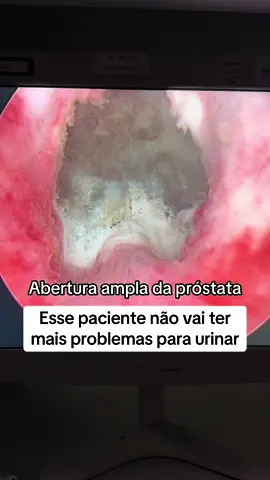 Pós operatório de vaporização da próstata com laser verde greenlight. Aspecto final excelente… esse paciente se livrou da próstata aumentada que causava vários problemas e alterava sua qualidade de vida #prostataaumentada #hiperplasiaprostaticabenigna #greenlight 