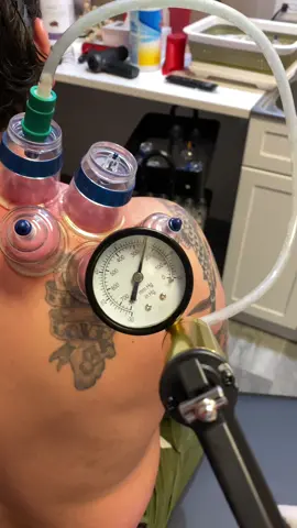 🏆 What is Cupping Therapy and Why It’s a Must for Athletes ▪️ Cupping therapy involves placing cups on the skin to create suction, which lifts the muscle and fascia, promoting blood flow, reducing inflammation, and releasing deep-seated tension. ▪️ How it works: The suction created by the cups helps to release tight muscles, increase mobility, and improve recovery. It’s perfect for breaking up scar tissue or relieving soreness after a hard workout or competition. ▪️ Benefits: Cupping helps speed up recovery, reduce muscle pain, improve flexibility, and enhance performance—whether you’re a runner, lifter, or field athlete, this technique helps you stay on top of your game. ▪️ The experience: As the cups are placed, you’ll feel a firm pressure that lifts and separates the muscle tissue. After the session, your muscles will feel looser, lighter, and more mobile, helping you bounce back faster. ▪️ Who it’s for: Cupping therapy is ideal for athletes who deal with muscle tightness, post-training soreness, or anyone looking to improve recovery and flexibility. It’s a key tool sports chiropractors use to keep you moving and injury-free. #ChicagoChiropractor #SportsChiropractor #RoscoeVillage #CuppingTherapy #AthleteRecovery #SportsPerformance #MuscleRelief #InjuryPrevention #SportsChiropractic #MyofascialRelease #PainRelief #DrKyleRoss #DrKaitHoff #DrAdamAltman #MyofascialDecompression #PhysicalTherapy #SportsRecovery #FitnessRecovery #MobilityTraining #PerformanceRehab #ActiveRecovery #AthleteWellness #ChiropracticCare #SportsMassage #InjuryRecovery #MobilityFitness #FascialRelease #strengthandrecovery 