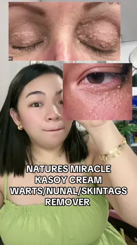 Replying to @lakwatsera/tiktokirista🤣 Kaya kung problema mo rin yung kulugo, millia, warts o buhay na nunal mo magcheck out kana ng kasoy cream. #kasoycream #naturesmiraclewartsremoval #naturesmiraclekasoycream #wartsremoval #trending #foryou #fyp #tiktokph 
