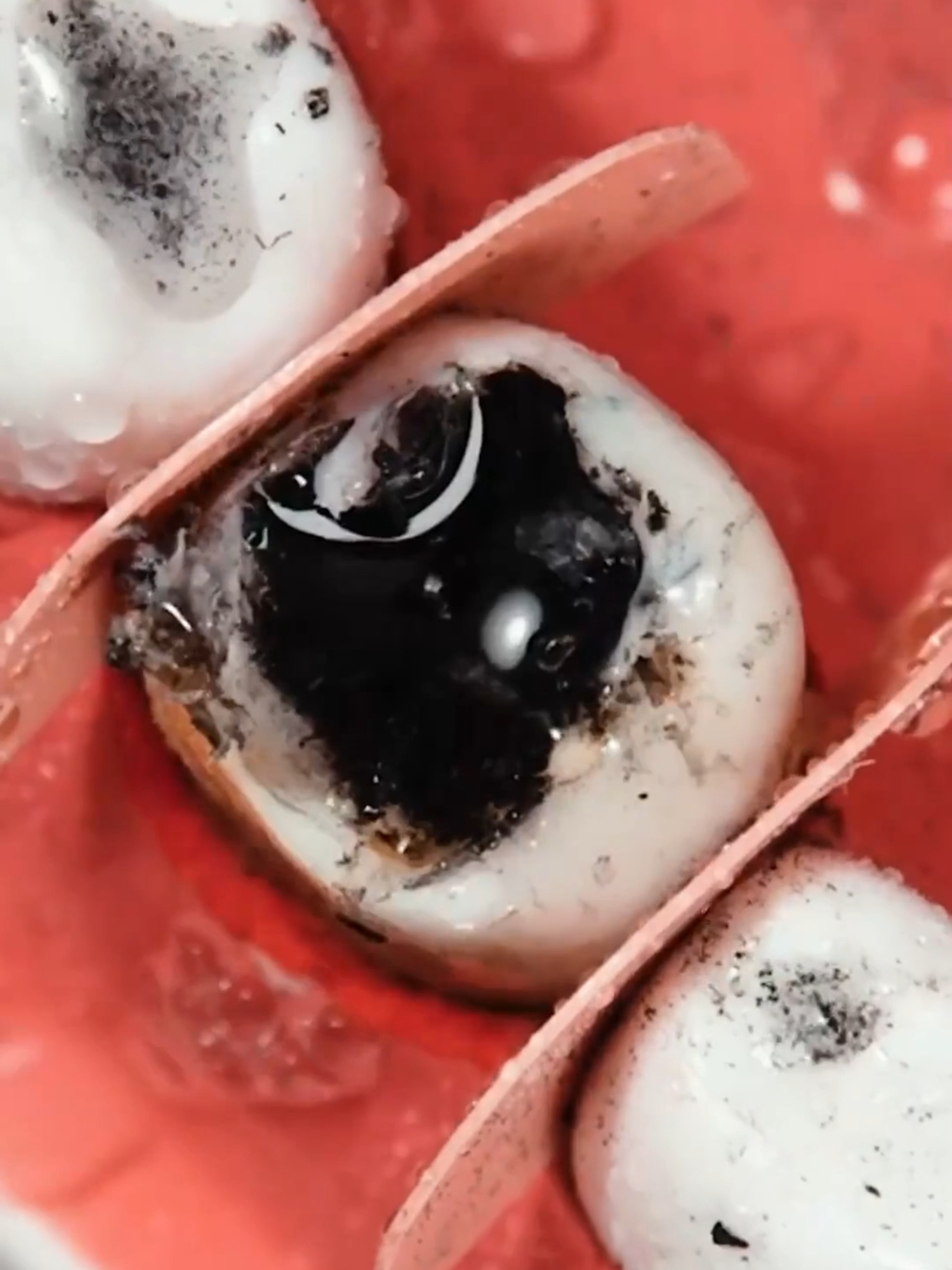 What a rotten tooth restoration looks like 🦷 #dentist #dentalcare #howto #doctor