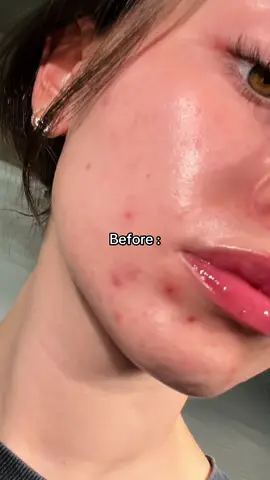 Skin glow up 🤭🤭 tretinoin made me get acne at first but now we looking gooddd #acne #beforeandafter #acnescars #acnefighter #skincare 