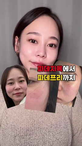 저는 심한 홍조와 트러블때문에 늘 두꺼운 화장으로 가리고 다녔어요 화장을 할수록 피부는 더 안좋아지고 민감해졌고 가렵고 따갑고 손으로 만지기 힘들 정도였어요 ㅠㅠ 안좋은 피부를 가리기를 포기하고 피부가 좋아지기 위해 파데프리를 시작했어요 :) 그랬더니 피부가 진짜 좋아졌어요,, 화장으로 인한 피부 답답함도 없고 화장 무너짐이나 끼임 걱정도 없고 무엇보다 피부가 좋아지니까 너무 좋더라구요! 사용한 파데프리 제품은 천연 베이지톤 재생크림 