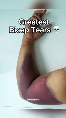 Last one so unlucky😭 #biceptear #biceps #gym #GymTok #gymfail #injury #bodybuilding #strongman #fy #foryou #viral #viraltiktok #trentwins 