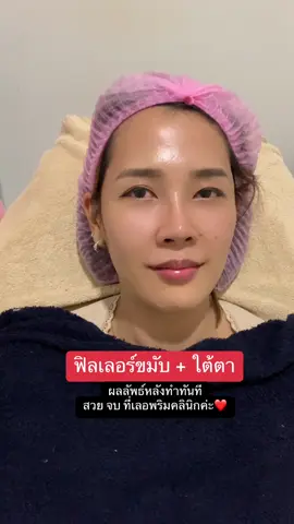 ปัญหาขมับตอบยุบ ร่องลึกใต้ตาคล้ำ ฉีดฟิลเลอร์ช่วยได้ค่ะ #leprimclinic #เลอพริมคลินิก #หมอพริม #สวย #อ่อนนุช #รีวิวบิวตี้ #fypシ゚viral #tiktokviral #fyp #ฟิลเลอร์ #ไม่ยอมแก่ 