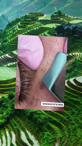 #pimple #acne #pimples #pimplepop #satisfyingvideo #pimplepopper #fyp