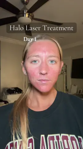 Heres what a week post halo laser treatment looks like!!! #acne #Lifestyle #skincare #halolasertreatment 